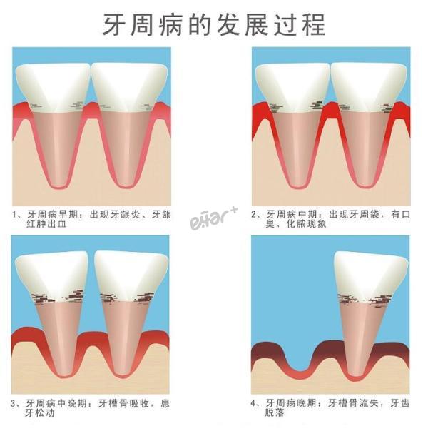 什么是牙齿疾病的维护治疗？