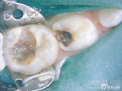 龋坏是怎么形成的