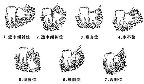老年人选择拔牙会有危险吗？
