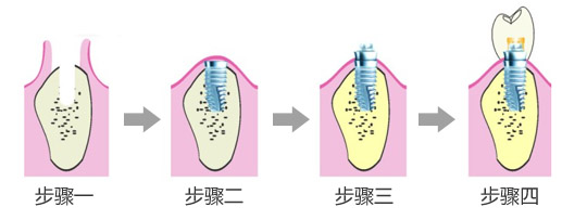 牙齿缺失后什么时候修复比较好？