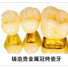 有关对黄金烤瓷牙的相关介绍？