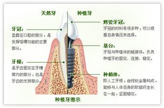 拔牙后是不是马上做种植牙吗？