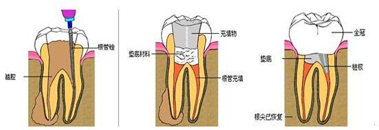 根管的治疗
