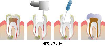 根管的治疗