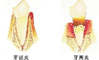 牙龈炎
